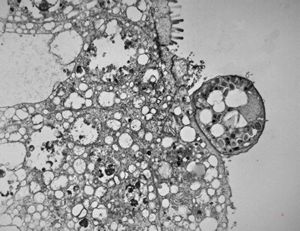 M,33y. | microsporidiosis (or cryptosporidiosis) - duodenum-posttransplantation immunodeficiency M,33y. | microsporidiosis (or cryptosporidiosis) - duodenum-posttransplantation immunodeficiency